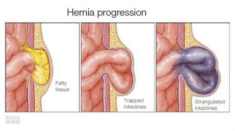 ‘Operation Hernia’ a success at GPHC - News Room Guyana