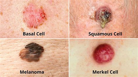 Skin Cancer Types Squamous Cell Carcinoma