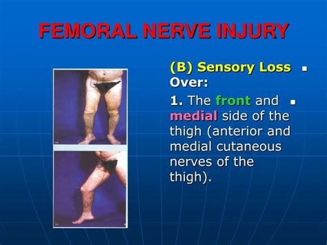 PPT - FEMORAL NERVE INJURY PowerPoint Presentation - ID:472761