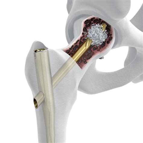 TFN-ADVANCED® Proximal Femoral Nailing System (TFNA) – Welcome to SYS Medtech International Pvt ...