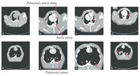 Computed tomographic pulmonary angiography. (a and e) Precontrast... | Download Scientific Diagram