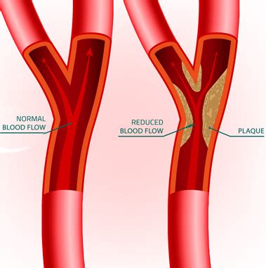 Carotid Artery Stenosis | Varicose veins | Vascular surgeon | Stroke | DVT | Leg gangrene | Cancer