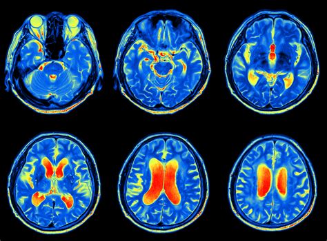 Brain scans may one day be used to predict dementia - Health, Brain and Neuroscience