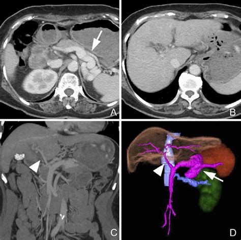 Figure1.A large splenorenal shunt in a 66-year-old woman who had liver... | Download Scientific ...