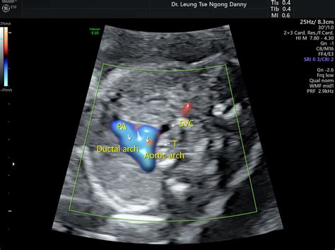 Aberrant right subclavian artery (ARSA): - HKOG-INFO