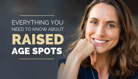 Everything You Need To Know About Treating Raised Age Spots