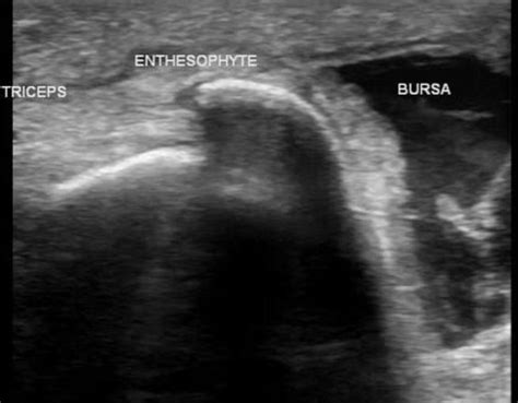 Olecranon Bursitis