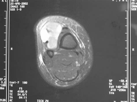 Synovial Sarcoma: Soft Tissue Sarcoma