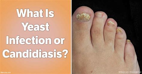 What Is Yeast Infection or Candidiasis?