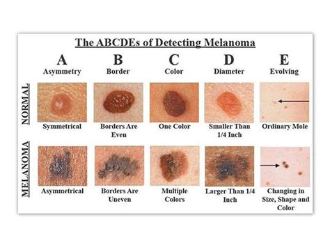 E (Evolving) change in the size, shape, or color of a mole or the appearance of a new spot.