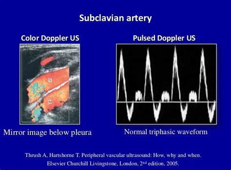 Doppler ultrasound of carotid arteries