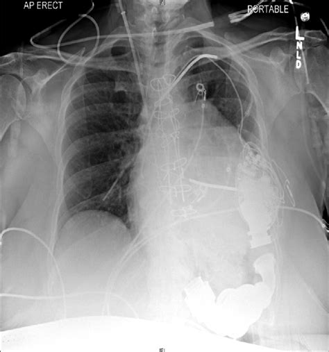 Pulmonary Artery Catheter Tip