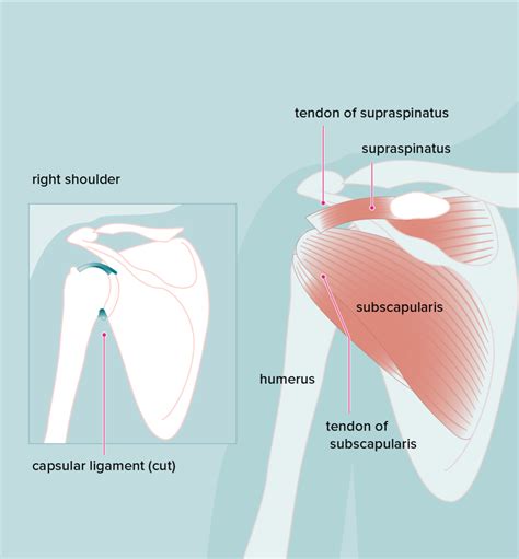 Dealing With Acromion Pain With The Best Exercises For Relief | Physiotherapists in Toronto ...