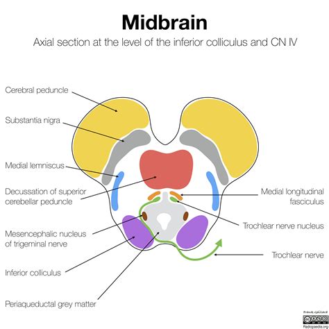 Radiopaedia - Drawing Midbrain at level of inferior colliculus and trochlear nerve - English ...