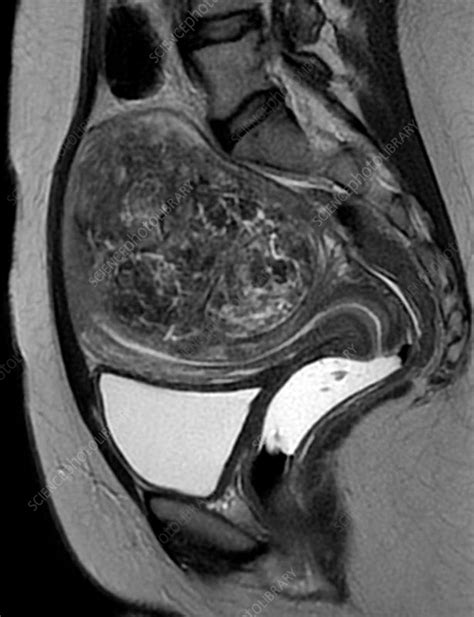 Uterine fibroid, MRI scan - Stock Image C034/5653 - Science Photo Library