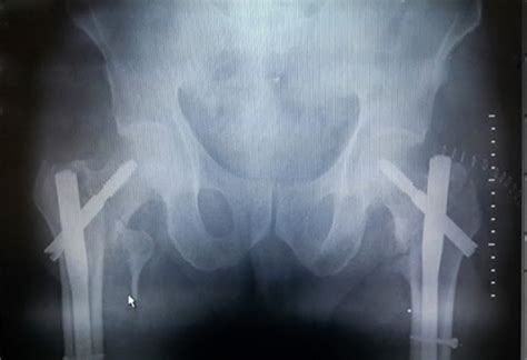 postoperative X­ray showing bilateral proximal femoral nail implementation. | Download ...