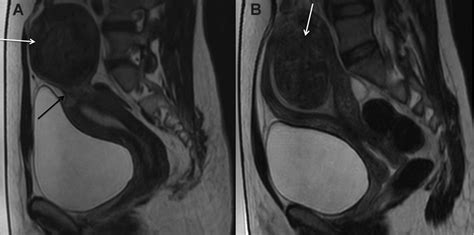 Pelvic Mri Fibroids