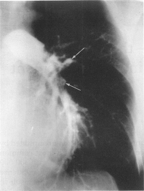 Figure Pulmonary angiogram obtained using a pulmonary artery catheter.... | Download Scientific ...