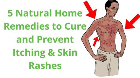 5 Natural Home Remedies to Cure and Prevent Itching & Skin Rashes - YouTube