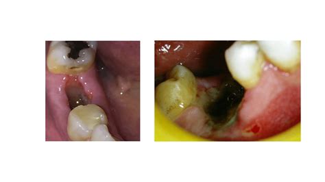 Tooth Extraction Complications: A Comprehensive Guide with Pictures