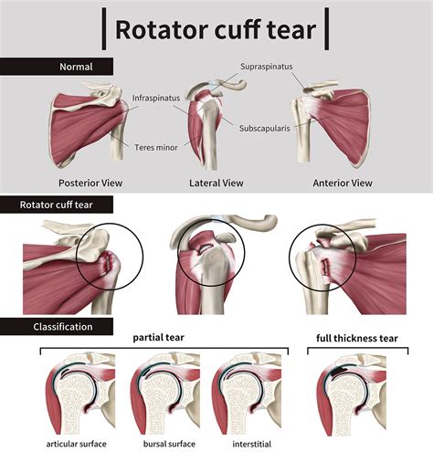 What Types Of Rotator Cuff Tears Require Surgery at Jerome Duke blog