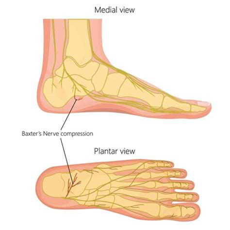 Baxter's Nerve Entrapment | Heel Pain Treatment | Melbourne Podiatrists