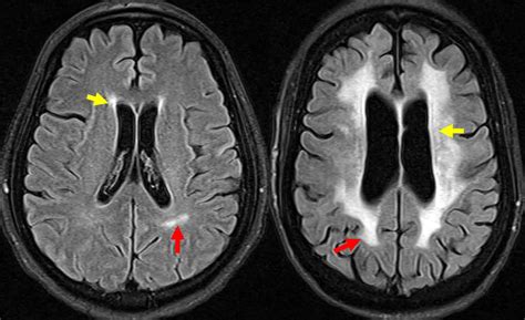 Study links left ventricular hypertrophy to deep white matter hyperintensities in patients with ...