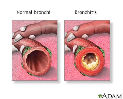 Bronchitis Symptoms, Doctors, Treatments, Advances & More | MediFind