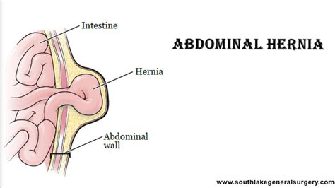 Abdominal Hernia- Symptoms, Diagnosis and Treatment | Southlake Texas