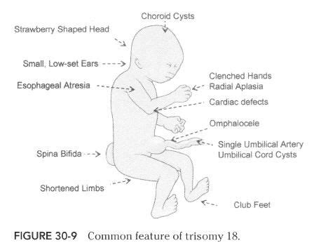 10 best images about Trisomy 18 (Edwards Syndrome) on Pinterest | Search, 13 and Triplets