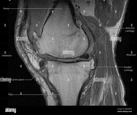 Knee Arthritis, MRI Stock Photo - Alamy