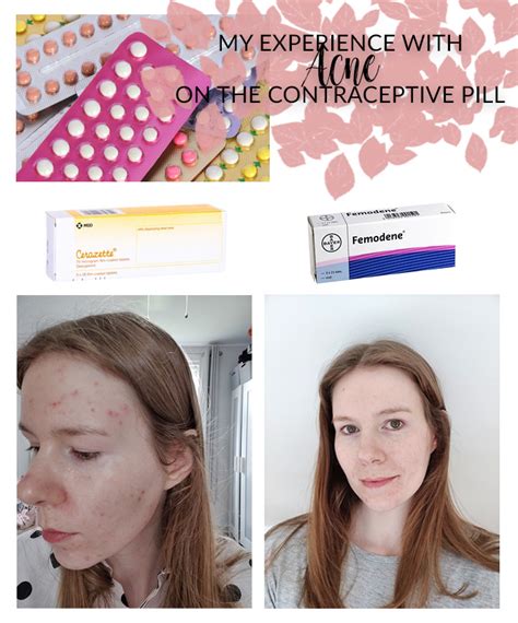 My experience with acne on the contraceptive pill (both the mini and combined pills) - Annie's Noms