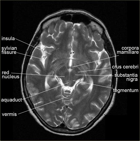 The Radiology Assistant : Brain Anatomy