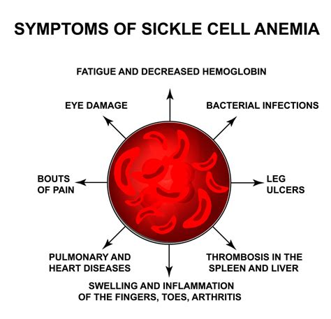 Sickle Cell Anemia and Vision | National Sickle Cell Month - Kadrmas Eye Care New England