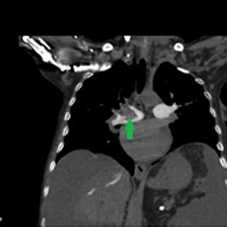 Computed tomography pulmonary angiography images of a 55-year-old... | Download Scientific Diagram