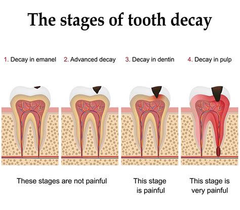 Tooth Decay Stages