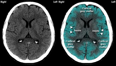 Ujjwal Upadhyay - Brain Anatomy using CT Scans