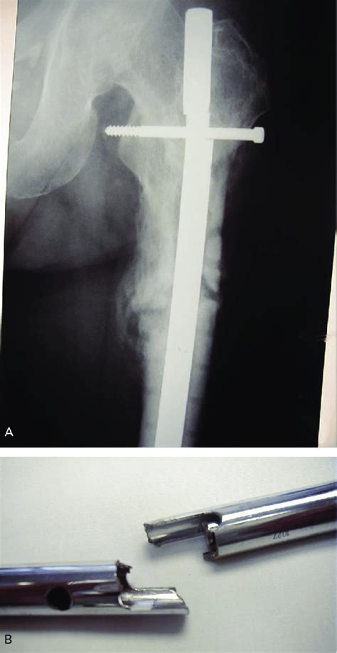 (A) A stainless steel antegrade femoral nail with fatigue failure of... | Download Scientific ...