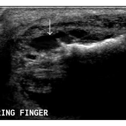 Synovial sarcoma. MRI (of the same patient as Figure 8). On T2W images... | Download Scientific ...