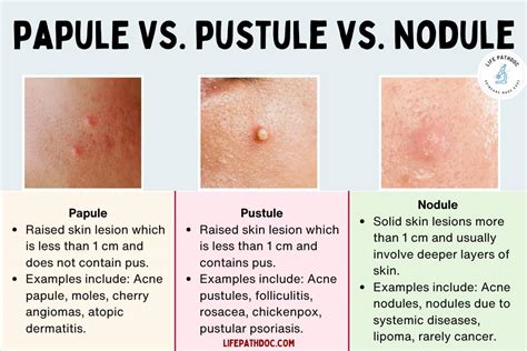 Papule vs Pustule vs Nodule: Pictures, Differences, and Causes