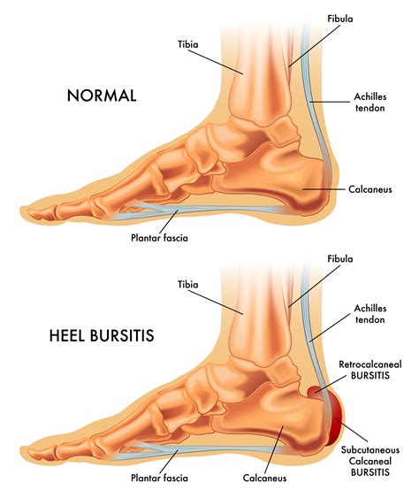 Bursitis Causes & Treatment – My FootDr