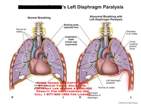 Diaphragm Paralysis