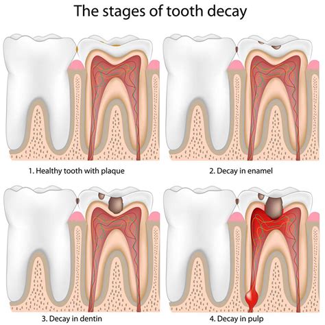 Tooth decay | healthdirect