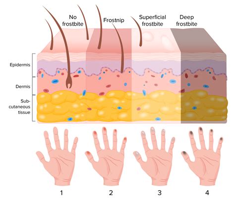 Queimadura de Frio | Concise Medical Knowledge