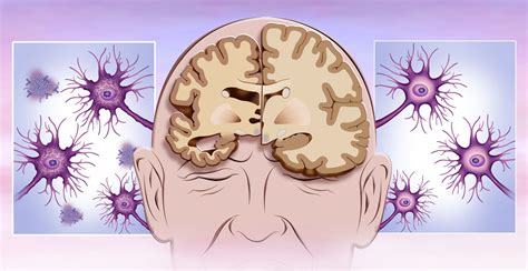 Stroke, Brain Injury, and Dementia: is there a link?