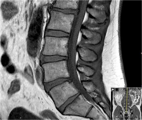 Lumbar Spine Mri Bulging Disc