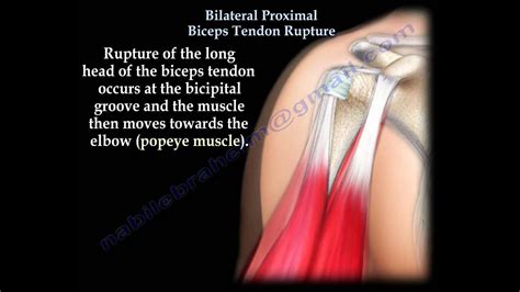 Long Head Biceps Tendon Subluxation