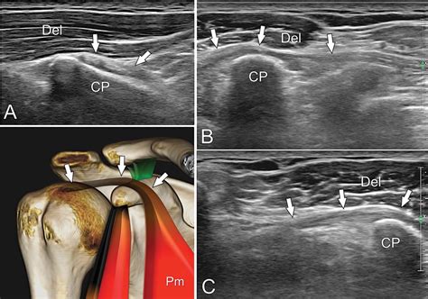 Coracohumeral Ligament Mri