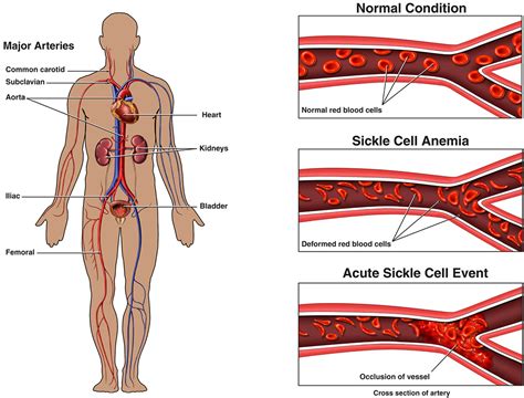 What is Sickle Cell Disease | City of Hope