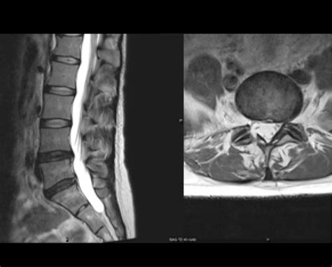 Lumbar Spine Mri Bulging Disc